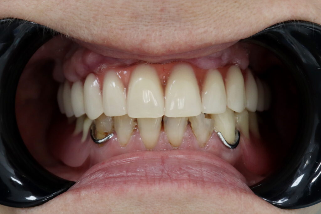 Результат имплантации