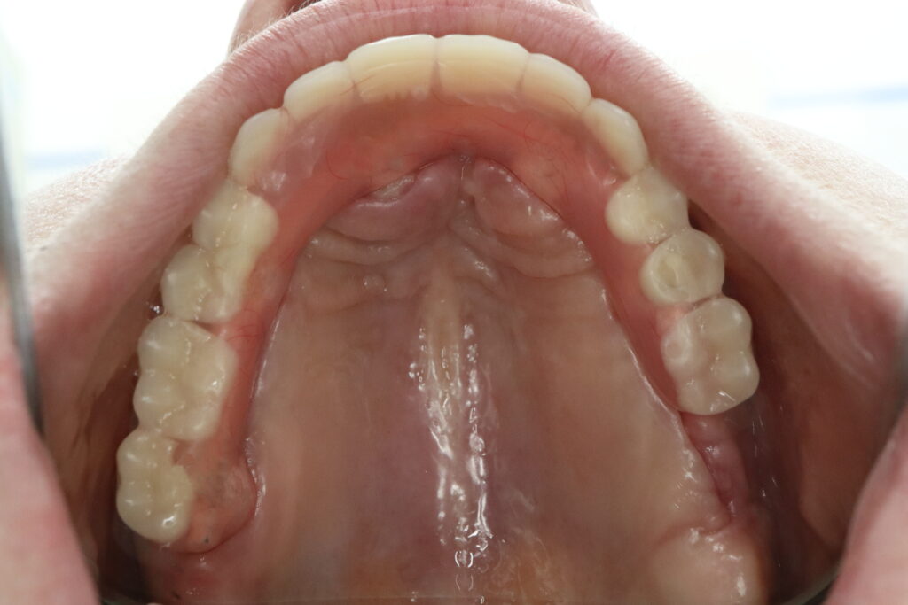 Результат имплантации