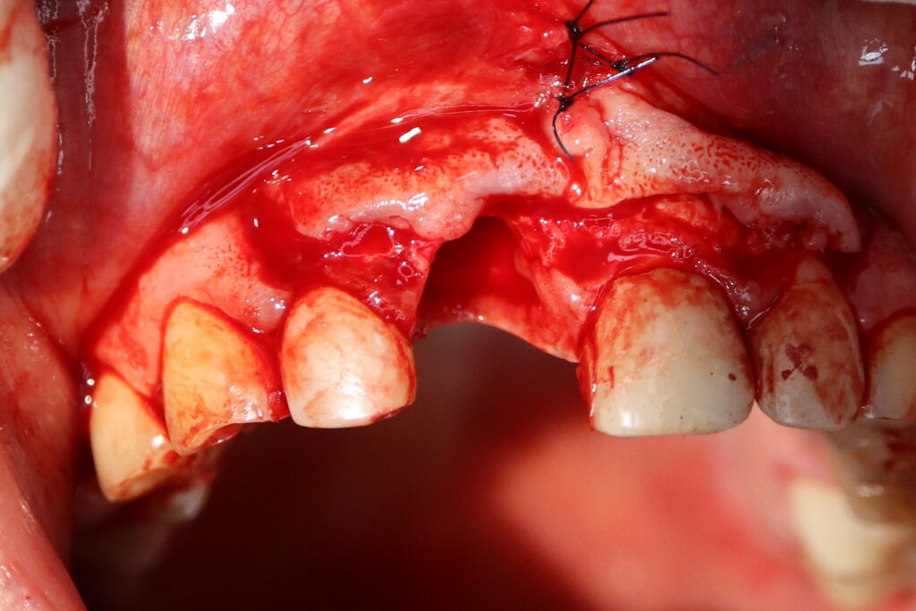 удаление зуба