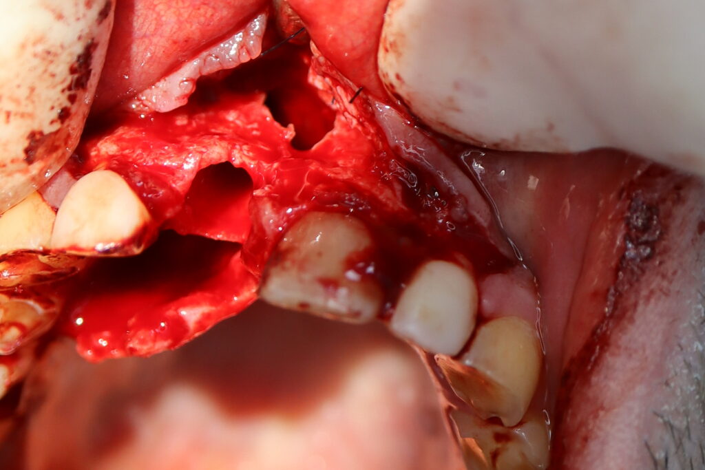 удаление зуба