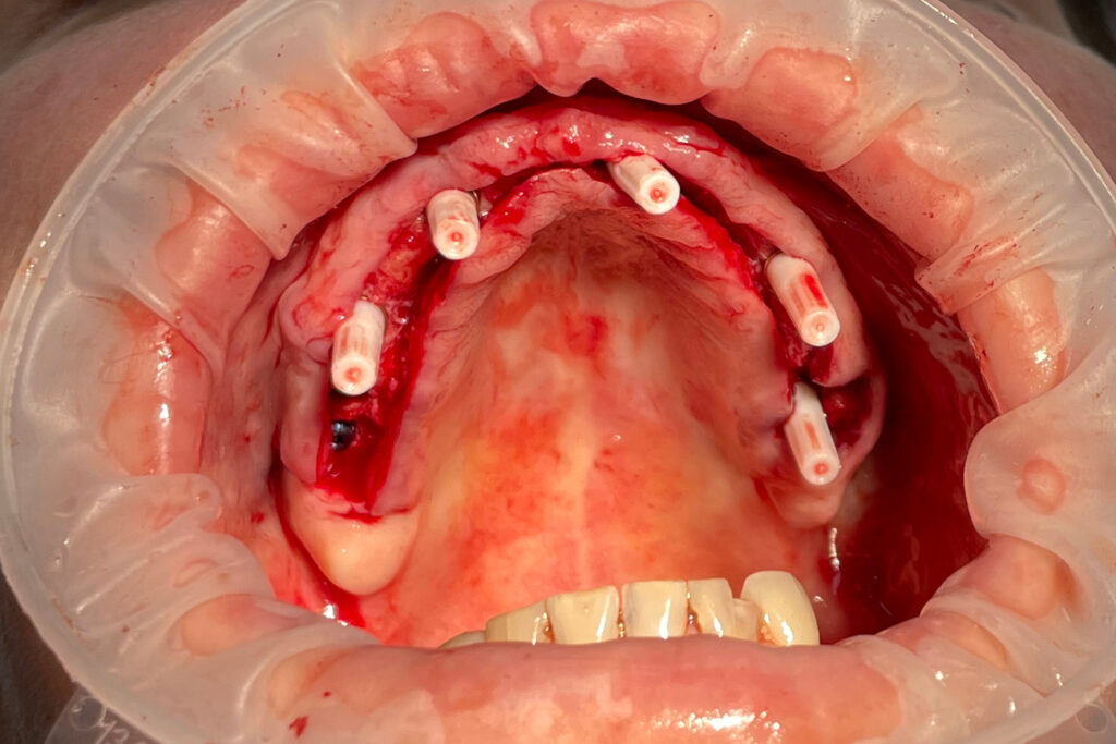 Процесс имплантации