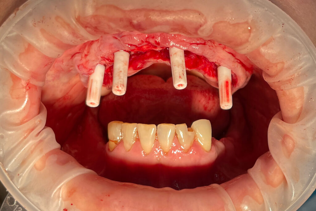 Процесс имплантации