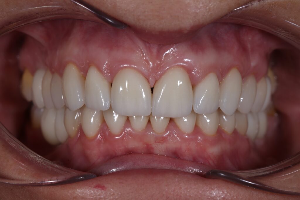 Комплексное лечение: ортодонтия, имплантация и протезирование.