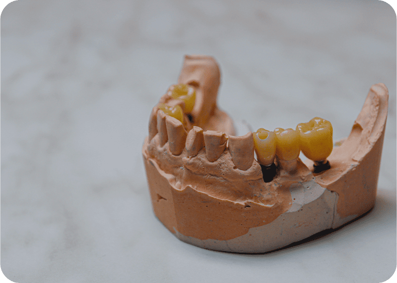 Протезирование