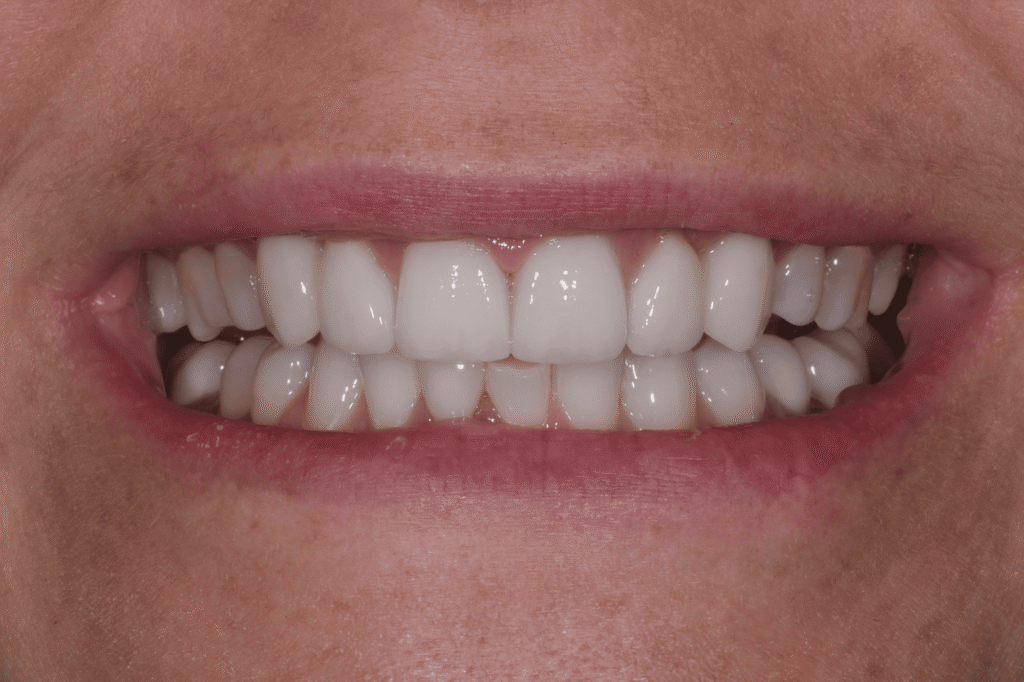 Имплантация и полная эстетическая реабилитация зоны улыбки