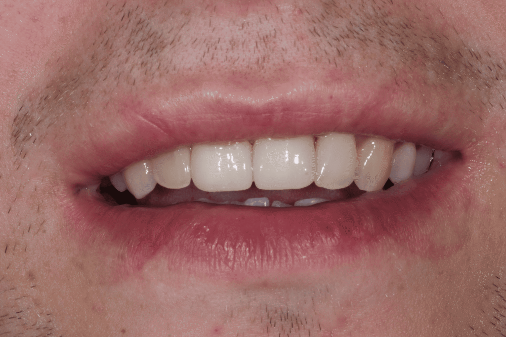 Эстетическая реставрация двух передних зубов: цирконий + стекловолоконный штифт