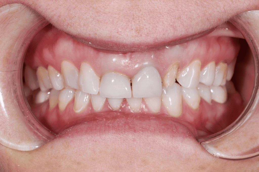 пациент до протезирования