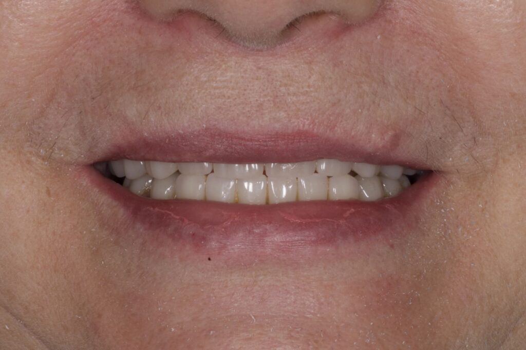 Комплексная имплантация по протоколу All-on-6 / All-on-4 — полное восстановление зубов верхней и нижней челюсти