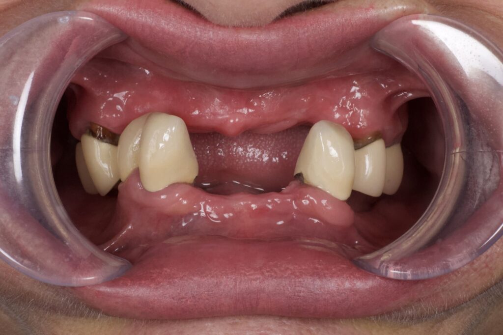 пациент до протезирования