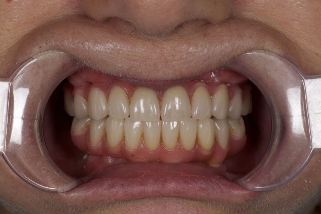 пациент после протезирования