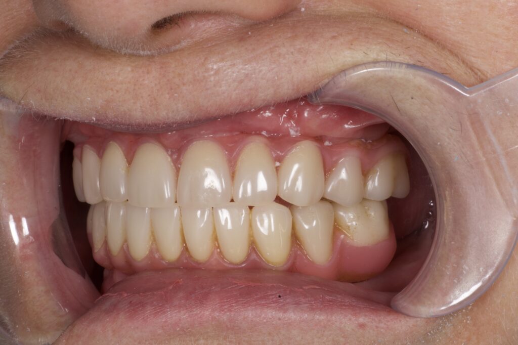 пациент после протезирования