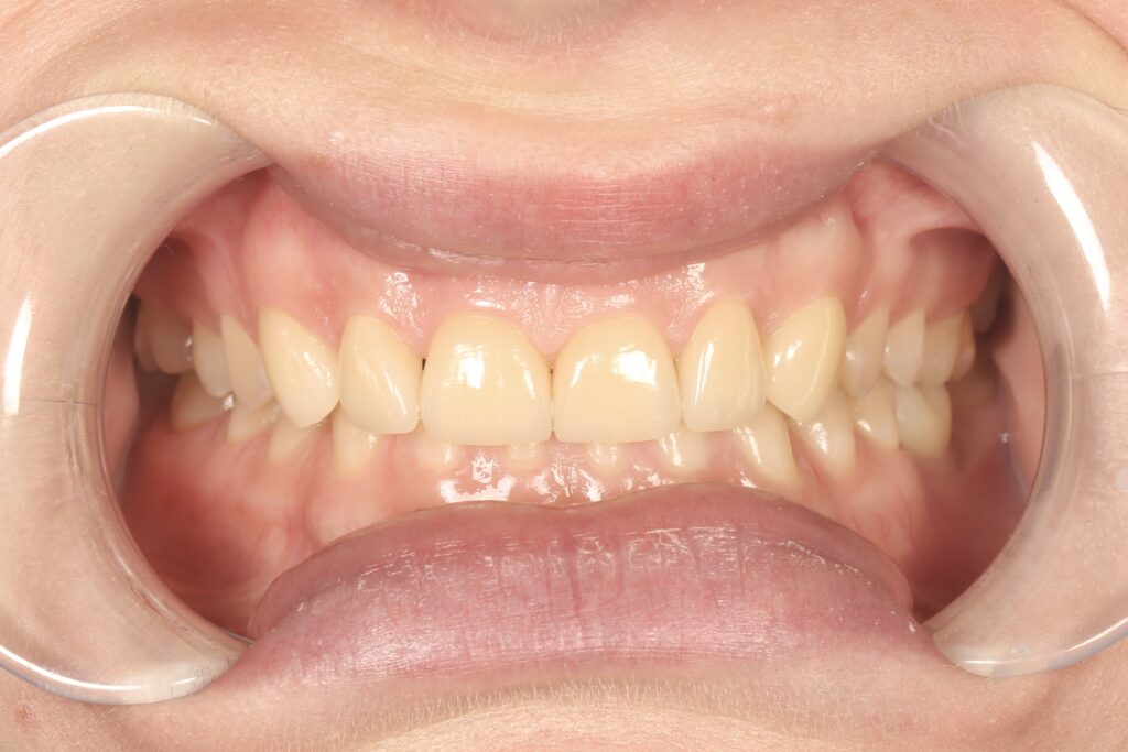 результат протезирования