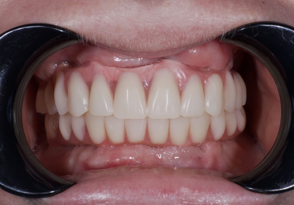 результат протезирования